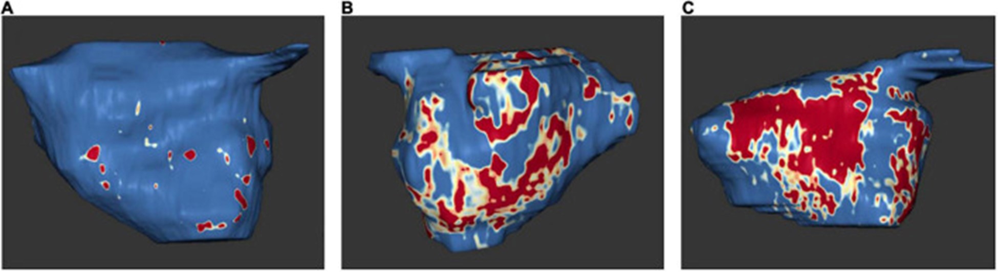 【佳学基因检测】左心房心肌病的基因解码、基因检测及其个性化的治疗
